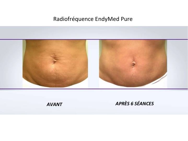 Radiofréquence EndyMed Pure 3 Deep Argenteuil 0