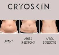 Cryolipolise CryoSkin 2.0 Colombes 0
