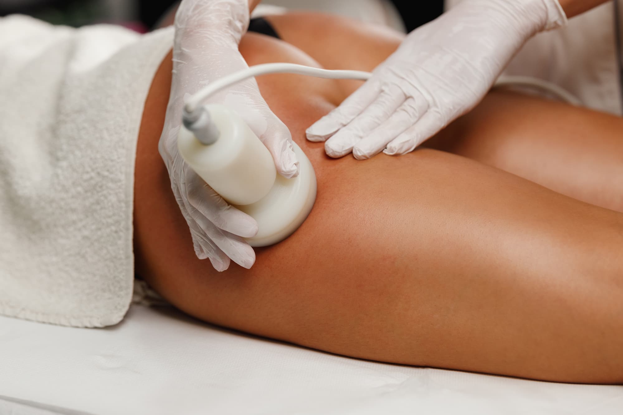 Quels sont les effets de la radiofréquence sur la cellulite ? Nanterre